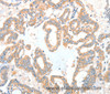 Immunohistochemistry of paraffin-embedded Human thyroid cancer tissue using ADCK1 Polyclonal Antibody at dilution 1:40