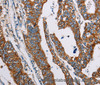 Immunohistochemistry of paraffin-embedded Human gasrtic cancer tissue using ALG2 Polyclonal Antibody at dilution 1:35