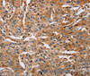 Immunohistochemistry of paraffin-embedded Human lung cancer using ACTA1 Polyclonal Antibody at dilution of 1:65