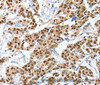 Immunohistochemistry of paraffin-embedded Human breast cancer tissue using ANXA10 Polyclonal Antibody at dilution 1:35