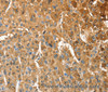 Immunohistochemistry of paraffin-embedded Human liver cancer tissue using ANXA9 Polyclonal Antibody at dilution 1:30