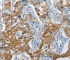 Immunohistochemistry of paraffin-embedded Human lung cancer tissue using NOL3 Polyclonal Antibody at dilution 1:35