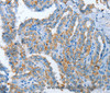 Immunohistochemistry of paraffin-embedded Human thyroid cancer tissue using ASL Polyclonal Antibody at dilution 1:35