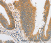 Immunohistochemistry of paraffin-embedded Human colon cancer tissue using ARHGAP5 Polyclonal Antibody at dilution 1:30