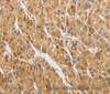 Immunohistochemistry of paraffin-embedded Human liver cancer tissue using ARHGAP5 Polyclonal Antibody at dilution 1:30