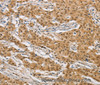 Immunohistochemistry of paraffin-embedded Human gastic cancer using ARHGAP25 Polyclonal Antibody at dilution of 1:40