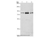 Western Blot analysis of Human brain malignant glioma tissue, A172 and 293T cell using ARHGEF7 Polyclonal Antibody at dilution of 1:800