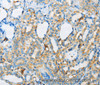 Immunohistochemistry of paraffin-embedded Human thyroid cancer tissue using ARSA Polyclonal Antibody at dilution 1:50