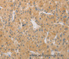 Immunohistochemistry of paraffin-embedded Human liver cancer tissue using ARSK Polyclonal Antibody at dilution 1:30