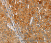 Immunohistochemistry of paraffin-embedded Human liver cancer tissue using ARSG Polyclonal Antibody at dilution 1:30