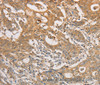 Immunohistochemistry of paraffin-embedded Human gastric cancer tissue using ARSG Polyclonal Antibody at dilution 1:30