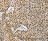 Immunohistochemistry of paraffin-embedded Human lung cancer using HSP40 Polyclonal Antibody at dilution of 1:40