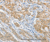 Immunohistochemistry of paraffin-embedded Human gastric cancer using HSP40 Polyclonal Antibody at dilution of 1:40