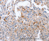 Immunohistochemistry of paraffin-embedded Human lung cancer tissue using NRG4 Polyclonal Antibody at dilution 1:60