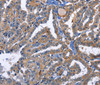 Immunohistochemistry of paraffin-embedded Human thyroid cancer using PKC delta Polyclonal Antibody at dilution of 1:30