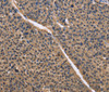 Immunohistochemistry of paraffin-embedded Human liver cancer using IDH1 Polyclonal Antibody at dilution of 1:50