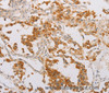 Immunohistochemistry of paraffin-embedded Human thyroid cancer tissue using STK40 Polyclonal Antibody at dilution 1:40