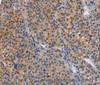 Immunohistochemistry of paraffin-embedded Human liver cancer tissue using MAP3K13 Polyclonal Antibody at dilution 1:40
