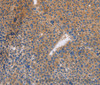 Immunohistochemistry of paraffin-embedded Human liver cancer tissue using NEK8 Polyclonal Antibody at dilution 1:30