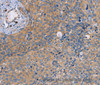Immunohistochemistry of paraffin-embedded Human cervical cancer tissue using NEK8 Polyclonal Antibody at dilution 1:30