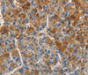 Immunohistochemistry of paraffin-embedded Human liver cancer tissue using CST4 Polyclonal Antibody at dilution 1:60