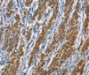 Immunohistochemistry of paraffin-embedded Human gasrtic cancer tissue using ACVR1 Polyclonal Antibody at dilution 1:60
