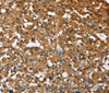 Immunohistochemistry of paraffin-embedded Human thyroid cancer tissue using DRAK2 Polyclonal Antibody at dilution 1:40