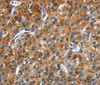 Immunohistochemistry of paraffin-embedded Human liver cancer tissue using DRAK2 Polyclonal Antibody at dilution 1:40