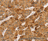 Immunohistochemistry of paraffin-embedded Human liver cancer tissue using LTB Polyclonal Antibody at dilution 1:45