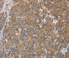 Immunohistochemistry of paraffin-embedded Human esophagus cancer using ACTN4 Polyclonal Antibody at dilution of 1:60