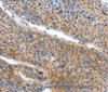 Immunohistochemistry of paraffin-embedded Human liver cancer tissue using ARL11 Polyclonal Antibody at dilution 1:50