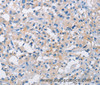 Immunohistochemistry of paraffin-embedded Human thyroid cancer tissue using ATP6AP2 Polyclonal Antibody at dilution 1:50