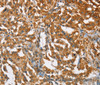 Immunohistochemistry of paraffin-embedded Human thyroid cancer using BCAP31 Polyclonal Antibody at dilution of 1:30