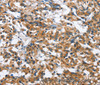 Immunohistochemistry of paraffin-embedded Human thyroid cancer tissue using BPI Polyclonal Antibody at dilution 1:50