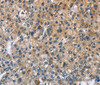 Immunohistochemistry of paraffin-embedded Human liver cancer tissue using BPI Polyclonal Antibody at dilution 1:50