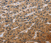 Immunohistochemistry of paraffin-embedded Human liver cancer tissue using EIF4EBP2 Polyclonal Antibody at dilution 1:40