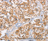 Immunohistochemistry of paraffin-embedded Human thyroid cancer tissue using EIF4EBP2 Polyclonal Antibody at dilution 1:40