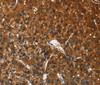 Immunohistochemistry of paraffin-embedded Human liver cancer tissue using CATSPER4 Polyclonal Antibody at dilution 1:50