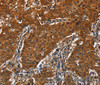 Immunohistochemistry of paraffin-embedded Human gastric cancer tissue using CATSPER4 Polyclonal Antibody at dilution 1:50
