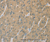Immunohistochemistry of paraffin-embedded Human liver cancer tissue using CYP2C9 Polyclonal Antibody at dilution 1:50