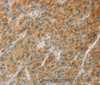 Immunohistochemistry of paraffin-embedded Human liver cancer tissue using CYP11B1 Polyclonal Antibody at dilution 1:30