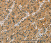 Immunohistochemistry of paraffin-embedded Human liver cancer tissue using CYP11A1 Polyclonal Antibody at dilution 1:50