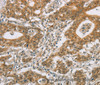 Immunohistochemistry of paraffin-embedded Human gastric cancer tissue using CYP11A1 Polyclonal Antibody at dilution 1:50