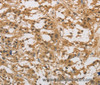 Immunohistochemistry of paraffin-embedded Human thyroid cancer using DAB2 Polyclonal Antibody at dilution of 1:30