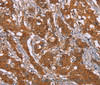 Immunohistochemistry of paraffin-embedded Human gasrtic cancer tissue using DCTN6 Polyclonal Antibody at dilution 1:40