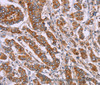 Immunohistochemistry of paraffin-embedded Human breast cancer tissue using DCTN6 Polyclonal Antibody at dilution 1:40