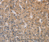 Immunohistochemistry of paraffin-embedded Human liver cancer tissue using DSTN Polyclonal Antibody at dilution 1:30