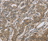 Immunohistochemistry of paraffin-embedded Human gastic cancer using DHRS3 Polyclonal Antibody at dilution of 1:30