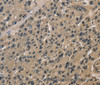 Immunohistochemistry of paraffin-embedded Human liver cancer tissue using CCAR1 Polyclonal Antibody at dilution 1:40