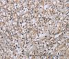 Immunohistochemistry of paraffin-embedded Human prostate cancer tissue using DTNB Polyclonal Antibody at dilution 1:50